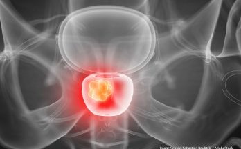 Abiraterone Risk Higher in Prostate Cancer Patients Who Have CVD
